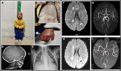 Hutchinson-Gilford progeria syndrome complicated with stroke: A report of 2 cases and literature review